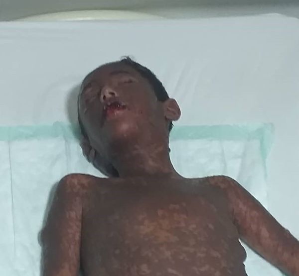 ظهور أعراض خطيرة في جسم طفل أُصيب في قصف صاروخي حوثي جنوب الحديدة 