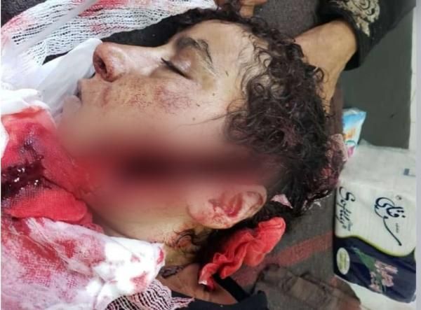 إصابة امرأة مسنة بعملية قنص حوثية جنوب تعز