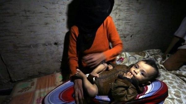 رصد 16 إصابة مؤكدة بشلل الأطفال في صعدة نتيجة رفض الحوثي حملات التطعيم