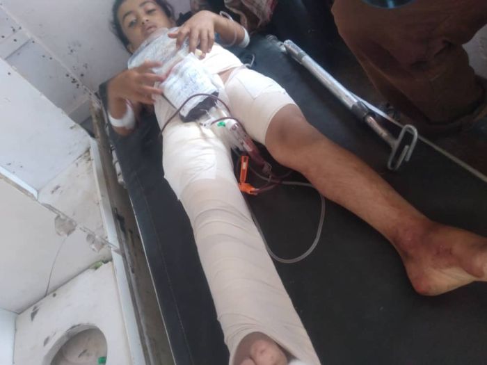 إصابة طفلة بطلقتي قناص حوثي شمال الضالع