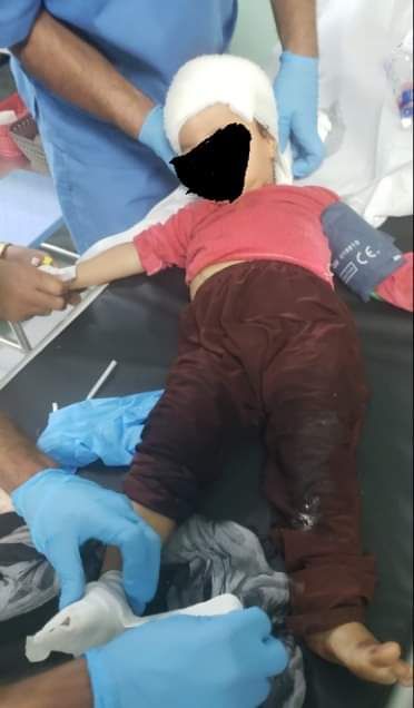 إصابة 3 أطفال من أسرة واحدة بانفجار مقذوف حوثي في الضالع