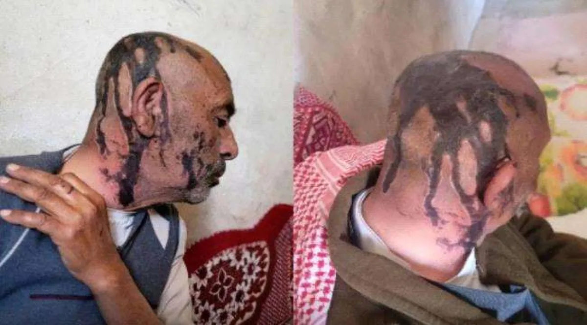 عنصران حوثيان يعتديان على والدهما المُسن بمادة حارقة في عمران