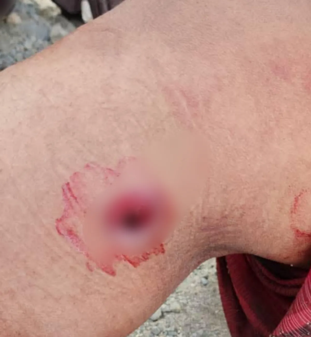 إصابة فتاة برصاصة قناص حوثي بعد ساعات من استشهاد طفل بتعز