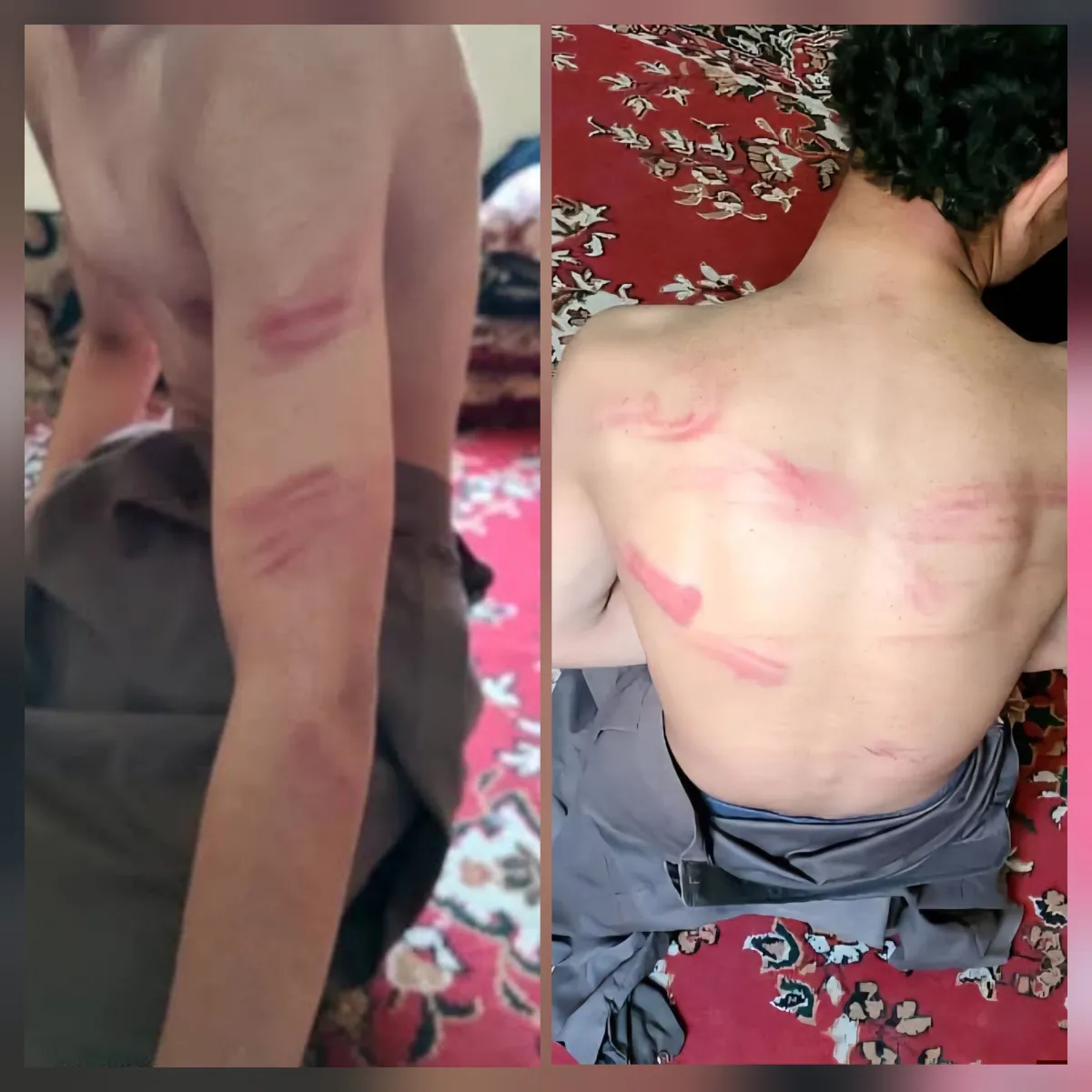 صعدة.. طفل يتعرض لتعذيب وحشي في سجون مليشيا الحوثي بعد اختطافه من ضحيان