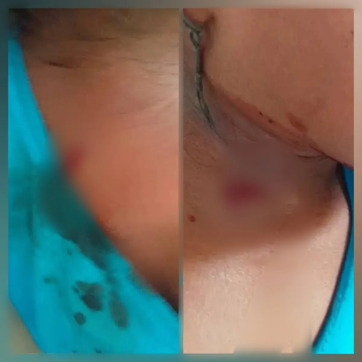 إصابة طفلة برصاص قناص حوثي غرب تعز