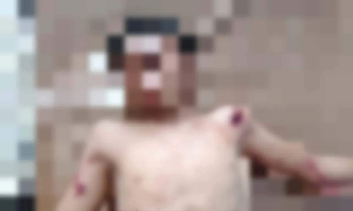 إصابة طفل بجروح خطرة في حيس بانفجار لغم حوثي وسط تصاعد زراعة الألغام